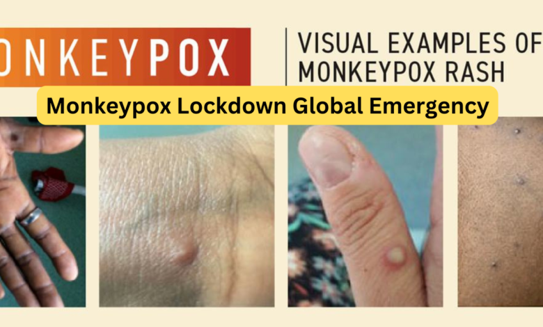 Monkeypox Lockdown